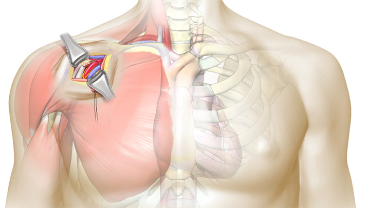 Advanced Thoracic Surgical Techniques