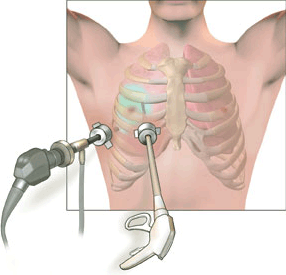 Minimally Invasive Thoracic Surgery