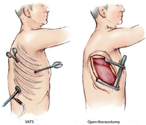 Open Thoracotomy