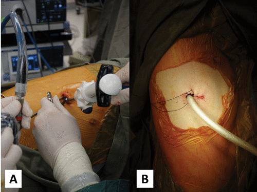 Surgery For Complicated TB