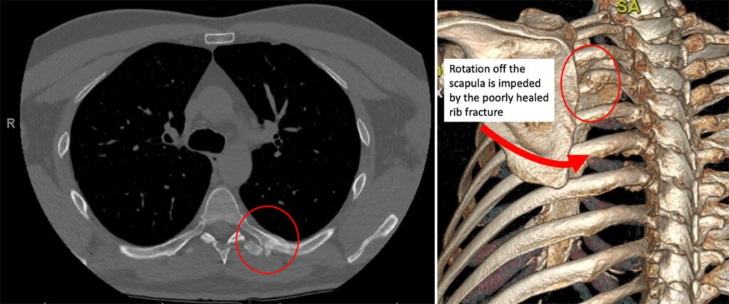 Surgery For Rib Fractures