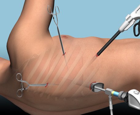 Video-Assisted Thoracic Surgery (VATS)