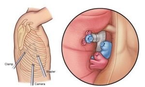 Lobectomy Procedure In Bhopal
