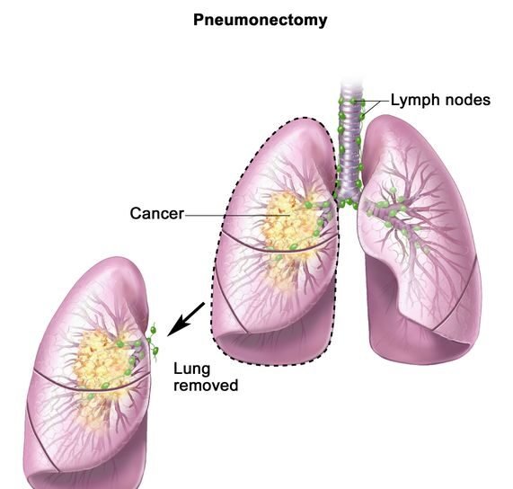 Pneumonectomy Surgery In Bhopal
