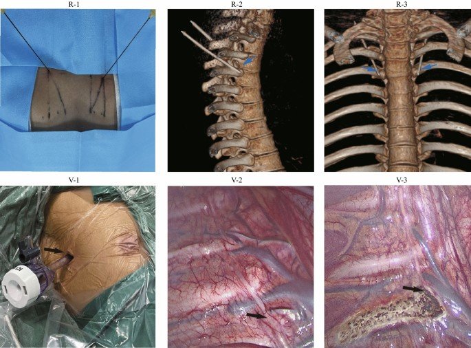 Hyperhidrosis Surgery In Korba