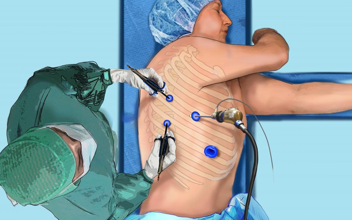 Lobectomy Procedure In Korba