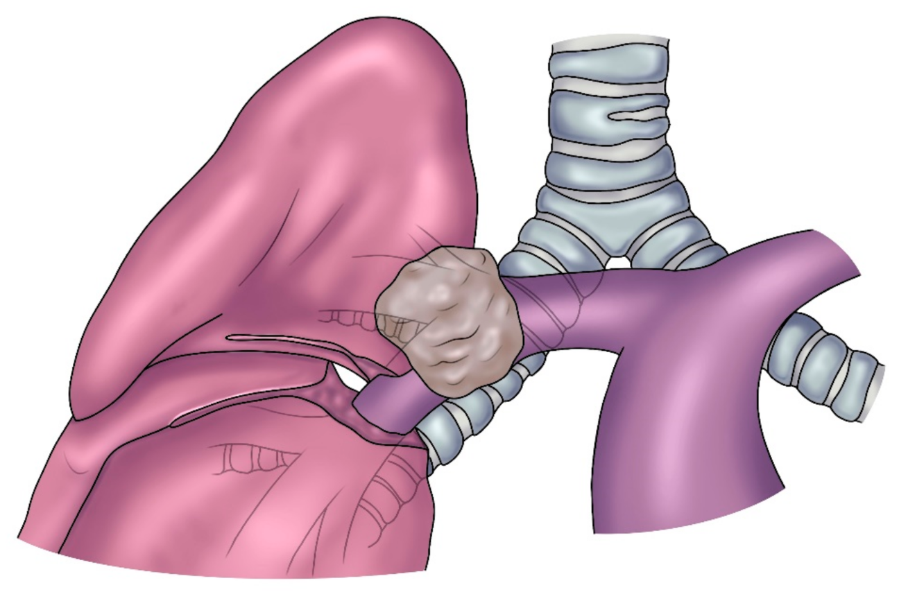 Lung Resection Surgery In Korba