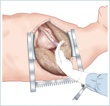 Open Thoracotomy In Korba