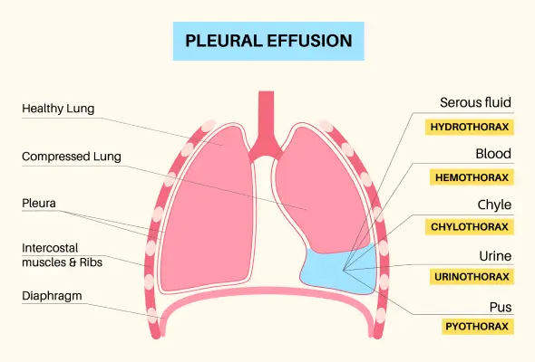 Pleural Effusion Treatment In Korba