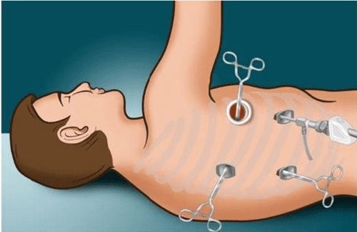 Video-Assisted Thoracic Surgery (VATS) In Korba